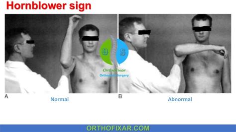 drop test shoulder examination|positive hornblower's sign.